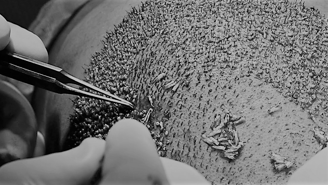 Hair Restoration Surgery Hair Restoration Surgery